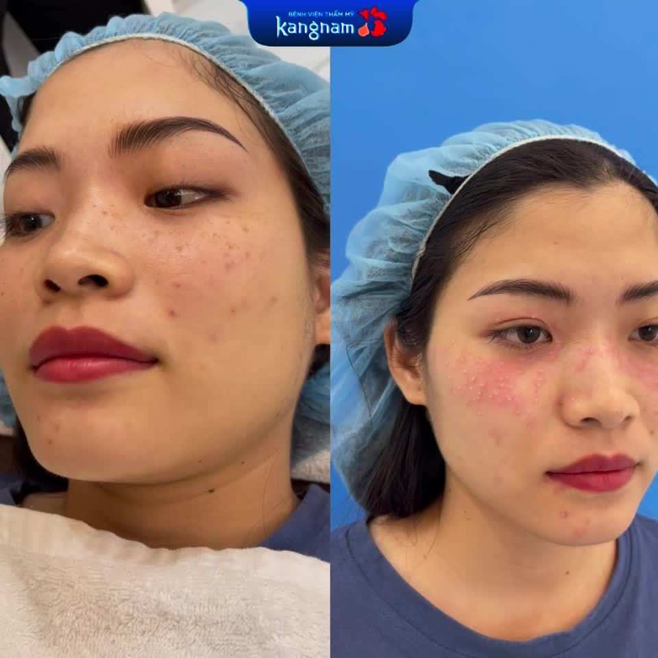 Cận cảnh làn da buổi đầu điều trị Tàn nhang
